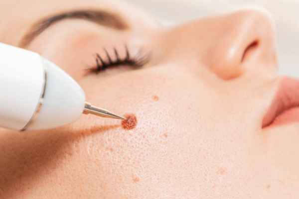 CryoPen: 5 Skin Concerns It May Be Used to Treat 3 What actually happens during a CryoPen treatment Uxbridge?