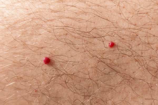 CryoPen: 5 Skin Concerns It May Be Used to Treat 2 cherry angioma removal Uxbridge