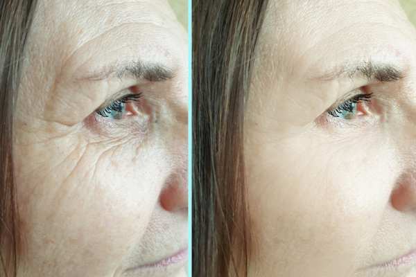 Why Do People Choose HIFU for a Non-Surgical Facelift? 4 How long can HIFU results last Uxbridge?