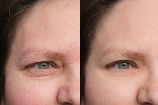 HIFU vs Botulinum Toxin: Understanding the Differences 4 How long do HIFU results last Uxbridge?