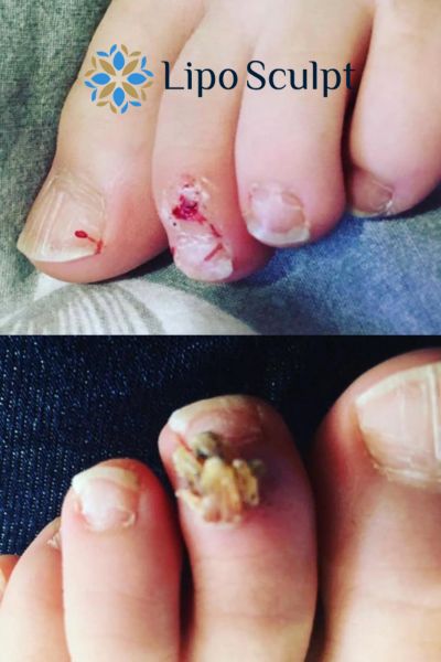 Wart removal customer results from Lipo Sculpt Uxbridge